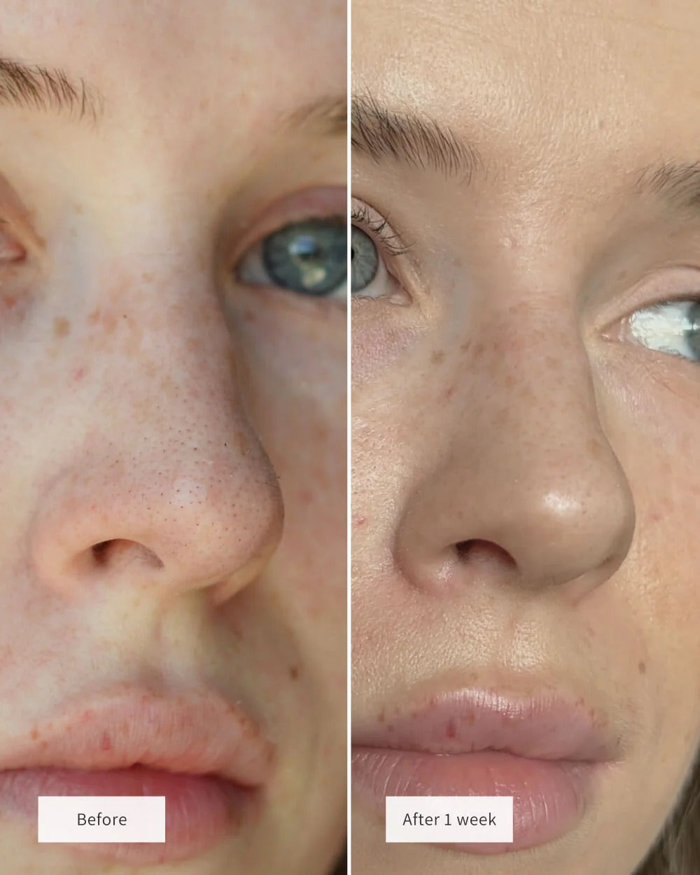 Anti-Blackheads Nose Patches