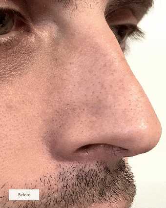 Anti-Blackheads Nose Patches