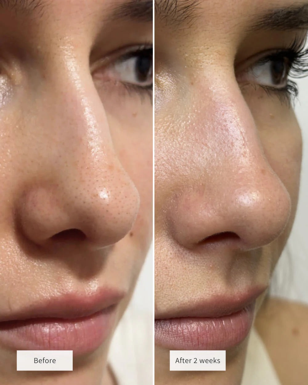 Anti-Blackheads Nose Patches