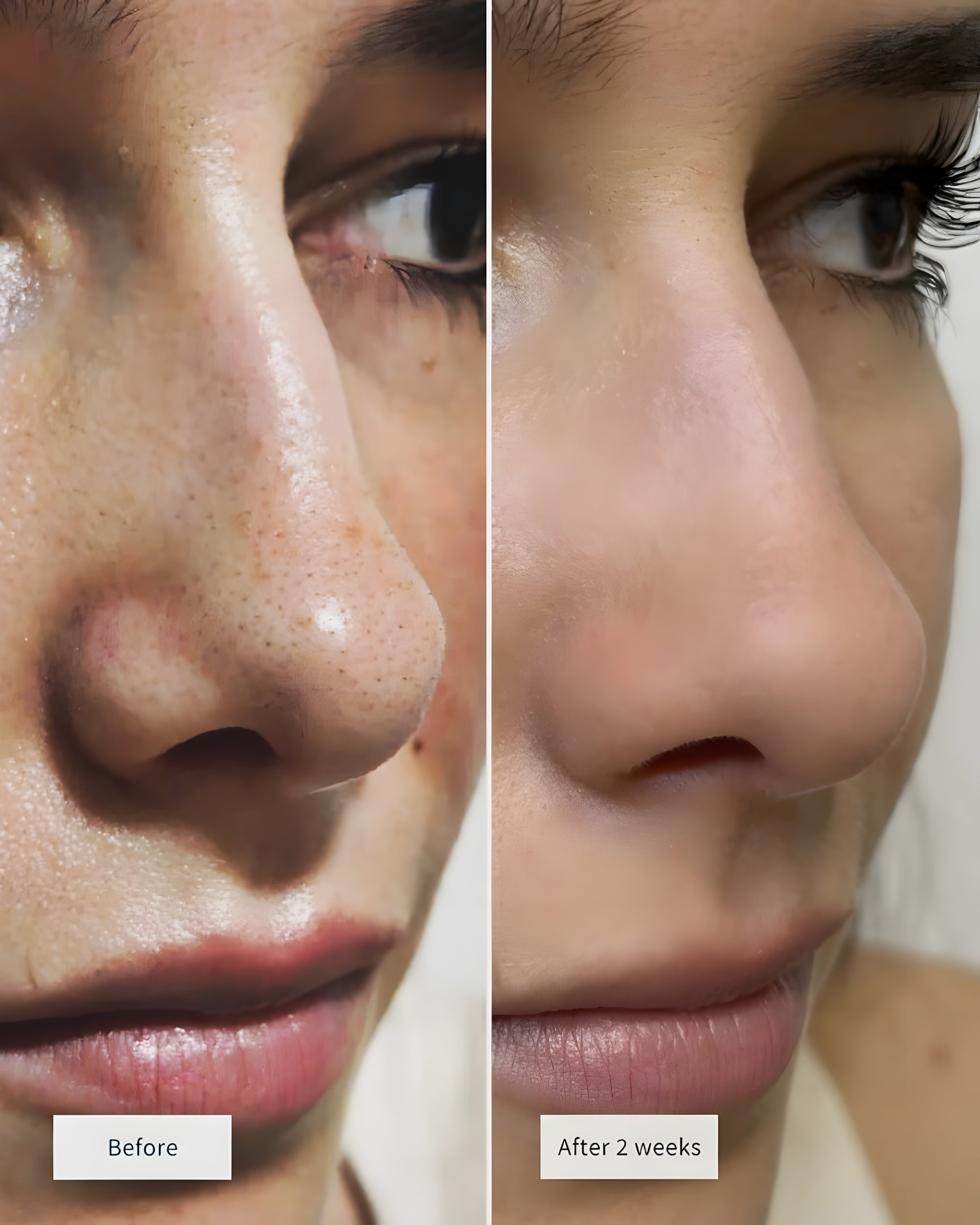 PorePearl™- Anti-Blackheads Nose Patches For Pearl Clear Skin